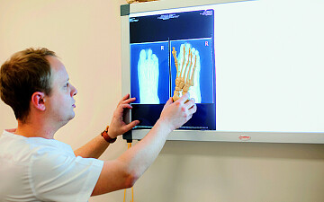 Если выпирает косточка большого пальца стопы: консультация травматолога-ортопеда